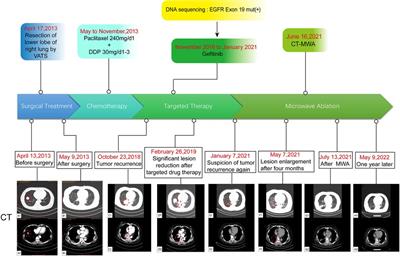 Recurrent lung adenocarcinoma benefits from microwave ablation following multidisciplinary treatments: A case with long-term survival